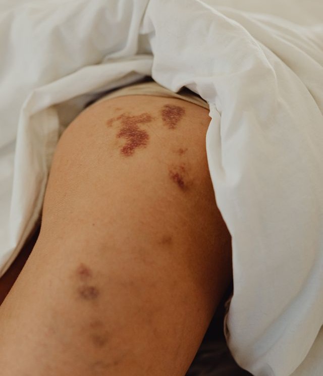 Advanced Venous Leg Ulcer Treatment in Kerala, Kochi